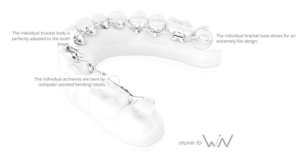 Win Lingual Systems Visible Results with Invisible Braces